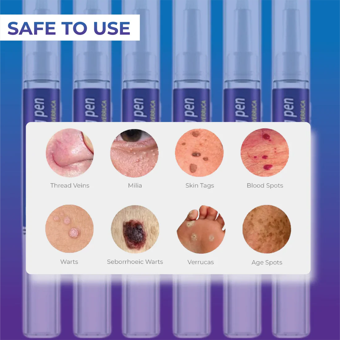 Stylo pour enlever les étiquettes de peau et les verrues (GNF)